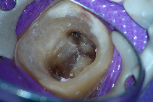 ラバーダム防湿